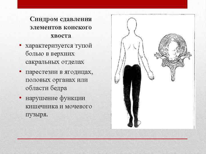 Синдром сдавления элементов конского хвоста • характеризуется тупой болью в верхних сакральных отделах •