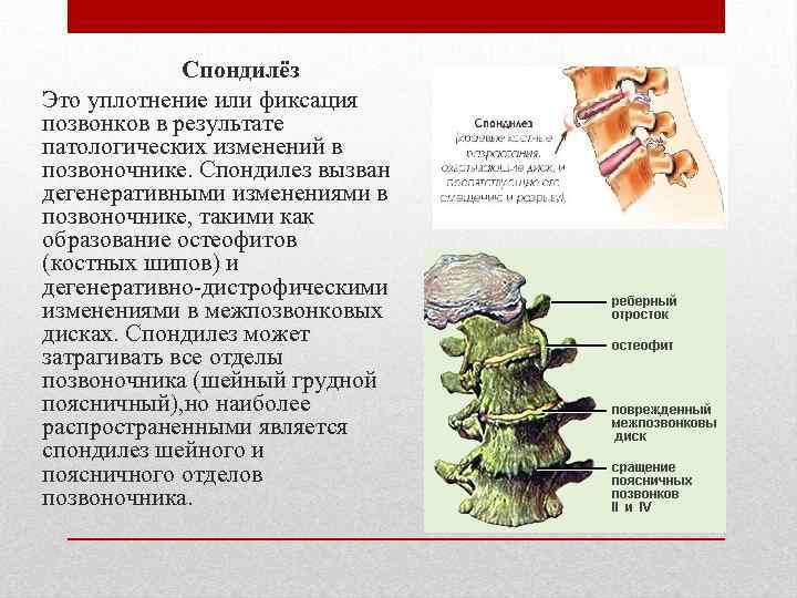  Спондилёз Это уплотнение или фиксация позвонков в результате патологических изменений в позвоночнике. Спондилез