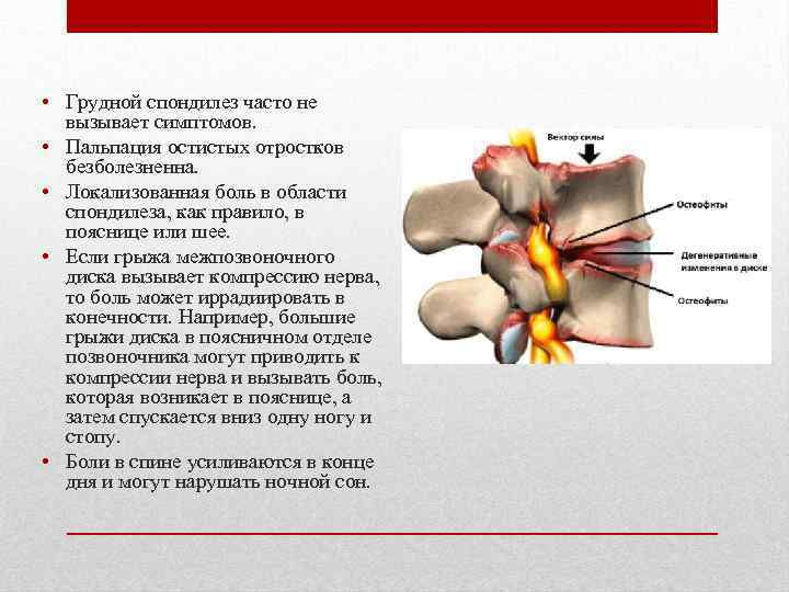  • Грудной спондилез часто не вызывает симптомов. • Пальпация остистых отростков безболезненна. •