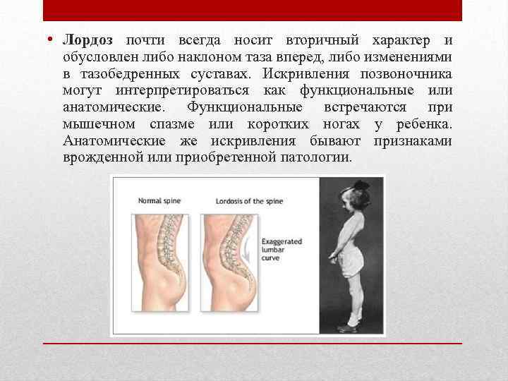  • Лордоз почти всегда носит вторичный характер и обусловлен либо наклоном таза вперед,