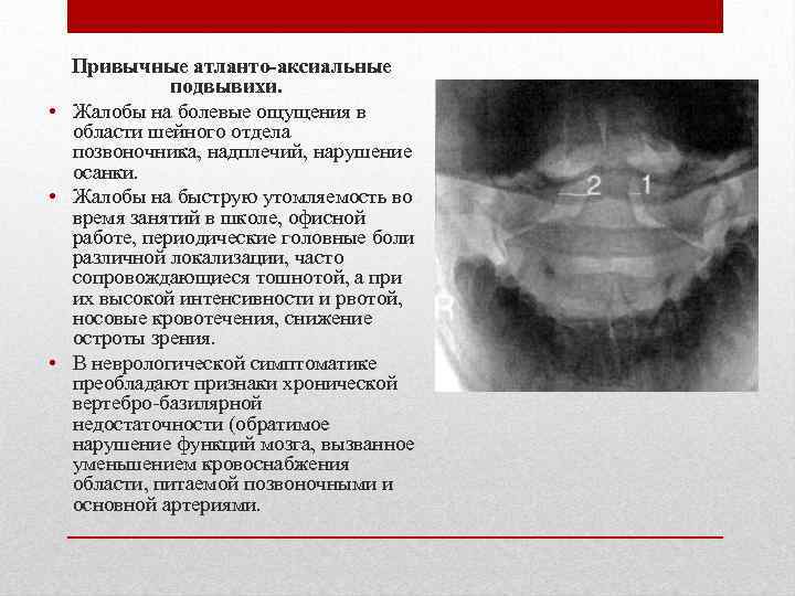 Привычные атланто-аксиальные подвывихи. • Жалобы на болевые ощущения в области шейного отдела позвоночника, надплечий,