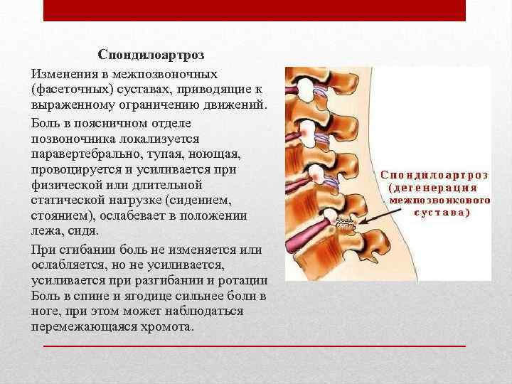 Спондилоартроз Изменения в межпозвоночных (фасеточных) суставах, приводящие к выраженному ограничению движений. Боль в поясничном