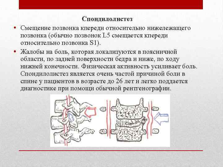 Спондилолистез • Смещение позвонка кпереди относительно нижележащего позвонка (обычно позвонок L 5 смещается кпереди