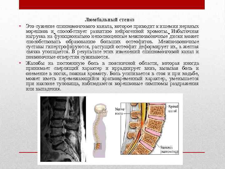 Люмбальный стеноз • Это сужение спинномозгового канала, которое приводит к ишемии нервных корешков и