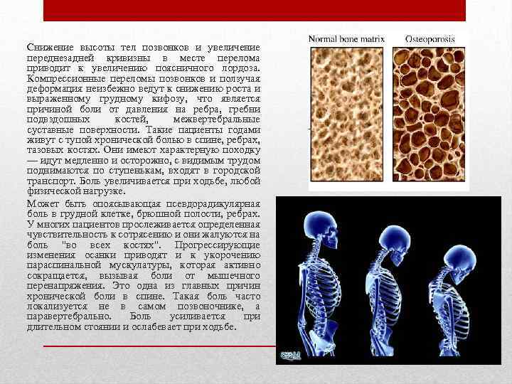 Снижение высоты тел позвонков и увеличение переднезадней кривизны в месте перелома приводит к увеличению