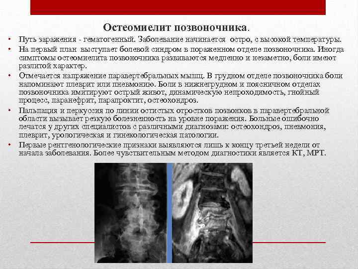  Остеомиелит позвоночника. • Путь заражения - гематогенный. Заболевание начинается остро, с высокой температуры.