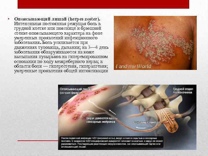  • Опоясывающий лишай (herpes zoster). Интенсивная постоянная режущая боль в грудной клетке или