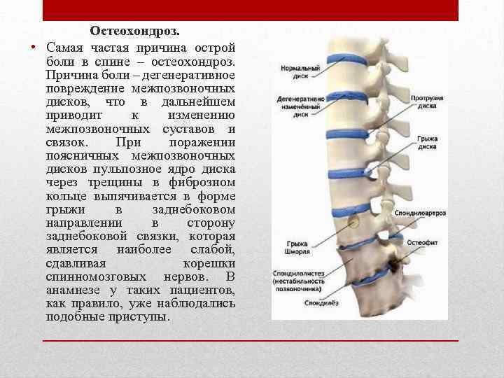 Остеохондроз. • Самая частая причина острой боли в спине – остеохондроз. Причина боли –