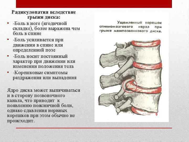  • • Радикулопатия вследствие грыжи диска: -Боль в ноге (ягодичной складке), более выражена