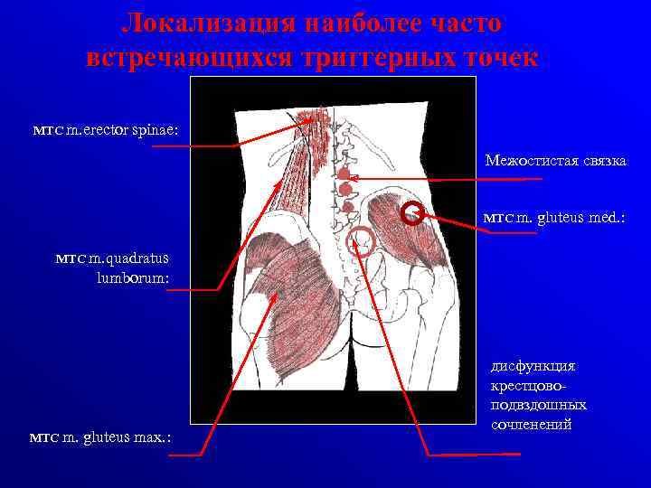 Локализация наиболее часто встречающихся триггерных точек МТС m. erector spinae: Межостистая связка МТС m.