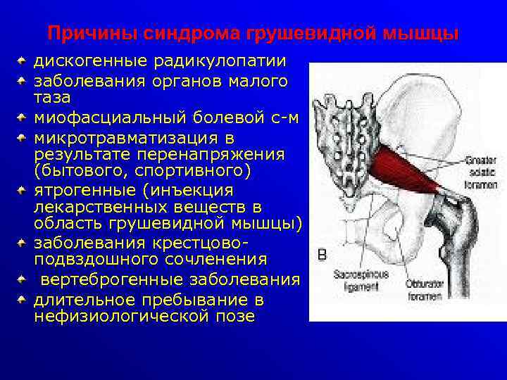 Причины синдрома грушевидной мышцы дискогенные радикулопатии заболевания органов малого таза миофасциальный болевой с-м микротравматизация