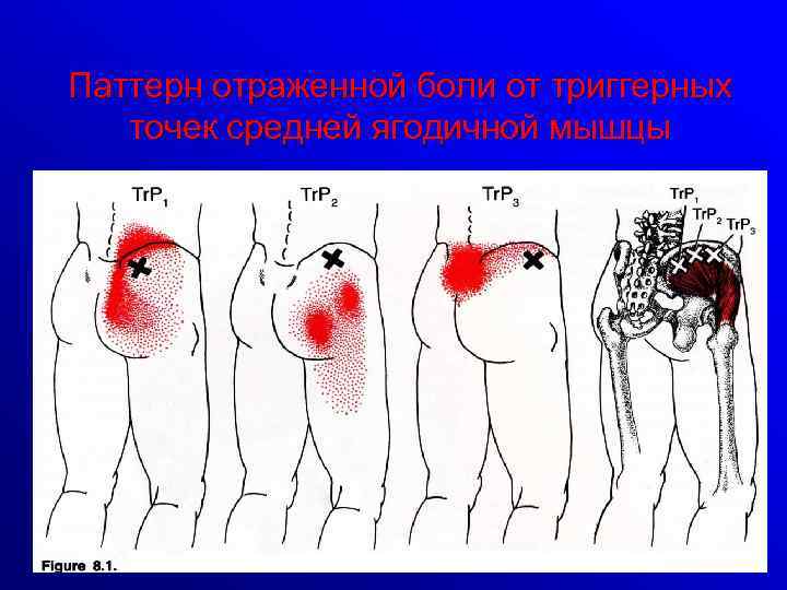 Паттерн отраженной боли от триггерных точек средней ягодичной мышцы 