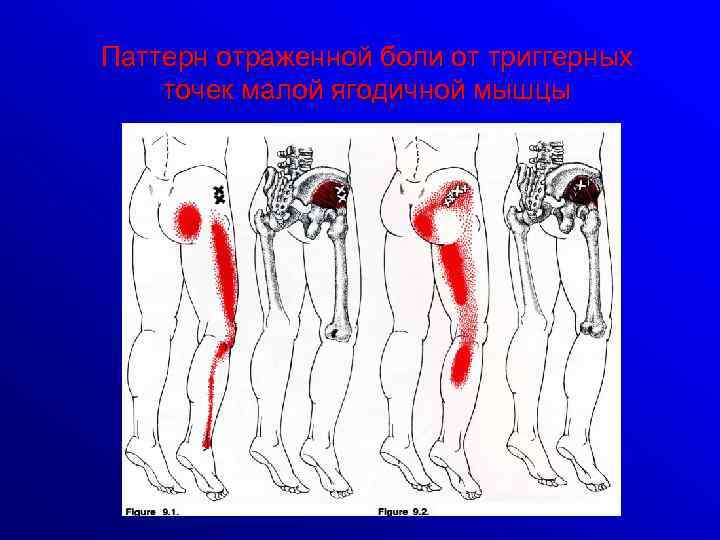 Паттерн отраженной боли от триггерных точек малой ягодичной мышцы 