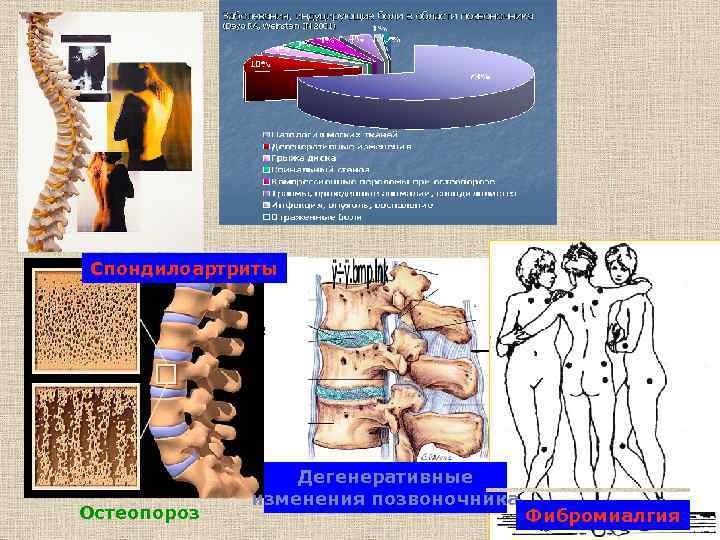 Спондилоартриты Фиброзное кольцо Остеопороз Дегенеративные изменения позвоночника Фибромиалгия 