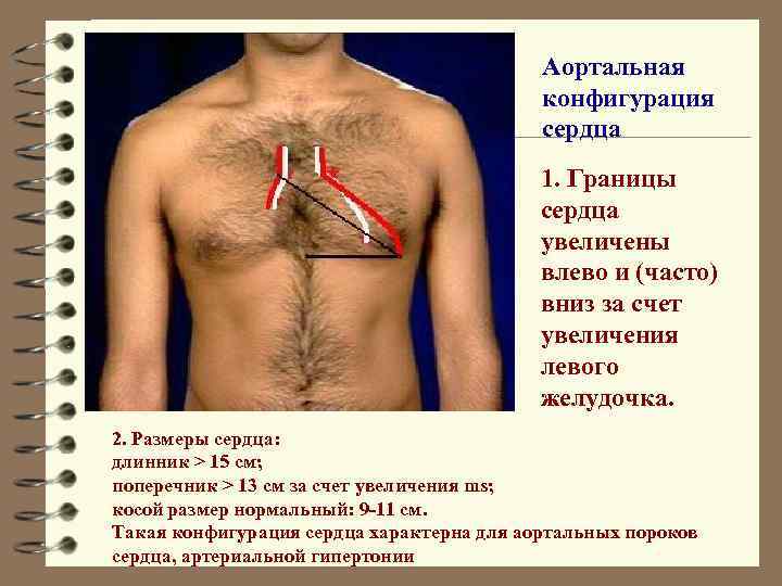 Аортальная конфигурация сердца 1. Границы сердца увеличены влево и (часто) вниз за счет увеличения