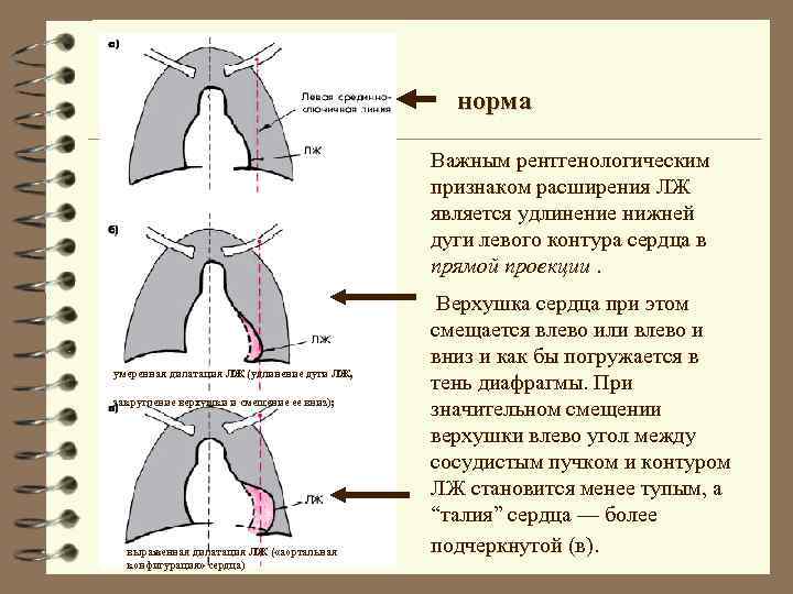 норма Важным рентгенологическим признаком расширения ЛЖ является удлинение нижней дуги левого контура сердца в
