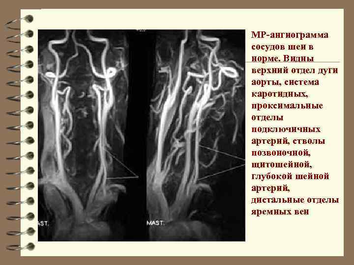 МР-ангиограмма сосудов шеи в норме. Видны верхний отдел дуги аорты, система каротидных, проксимальные отделы