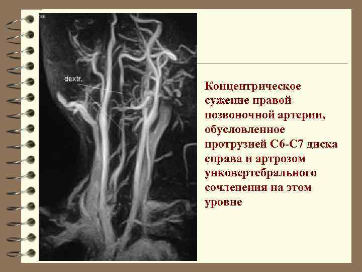 Концентрическое сужение правой позвоночной артерии, обусловленное протрузией С 6 -С 7 диска справа и