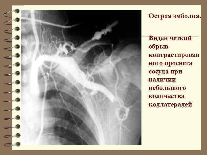 Острая эмболия. Виден четкий обрыв контрастирован ного просвета сосуда при наличии небольшого количества коллатералей