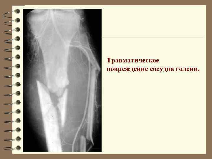 Травматическое повреждение сосудов голени. 