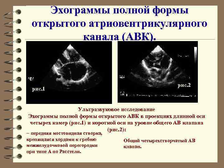Эхограммы полной формы открытого атриовентрикулярного канала (АВК). рис. 1 рис. 2 Ультразвуковое исследование Эхограммы