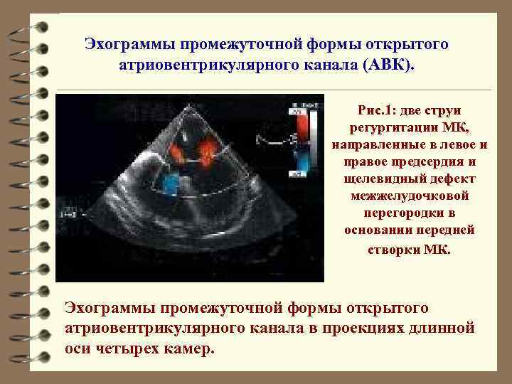 Эхограммы промежуточной формы открытого атриовентрикулярного канала (АВК). Рис. 1: две струи регургитации МК, направленные