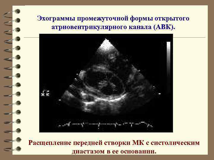 Эхограммы промежуточной формы открытого атриовентрикулярного канала (АВК). Расщепление передней створки МК с систолическим диастазом