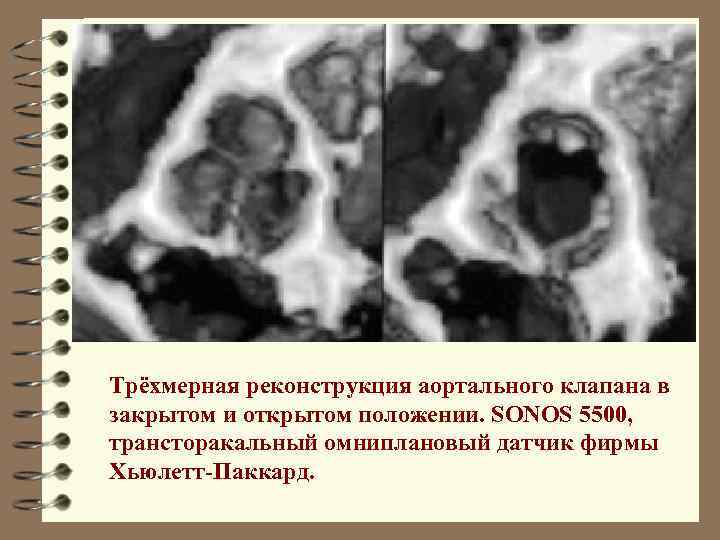 Трёхмерная реконструкция аортального клапана в закрытом и открытом положении. SONOS 5500, трансторакальный омниплановый датчик