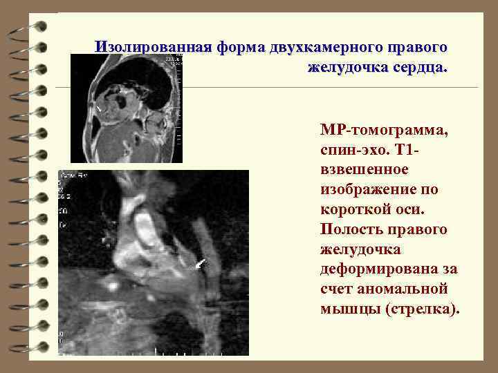 Изолированная форма двухкамерного правого желудочка сердца. МР-томограмма, спин-эхо. Т 1 взвешенное изображение по короткой