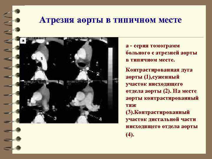 Атрезия аорты в типичном месте а - серия томограмм больного с атрезией аорты в