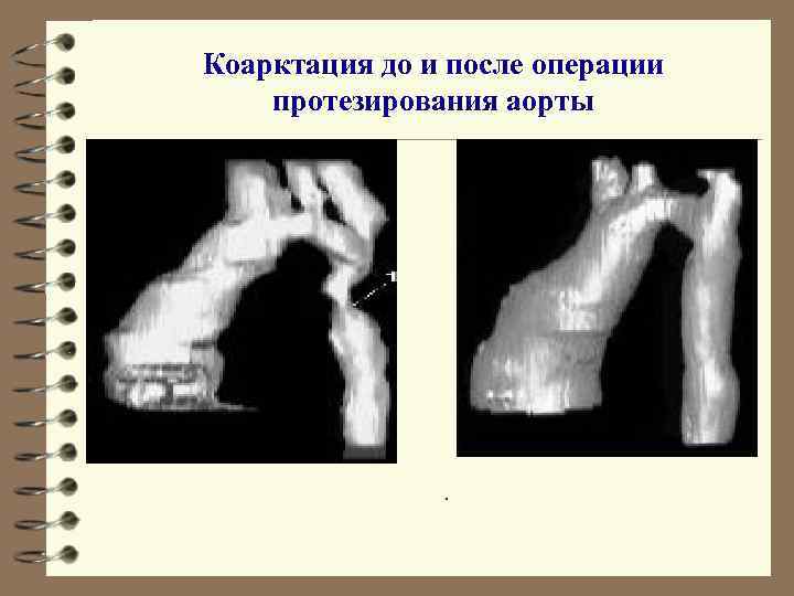 Коарктация до и после операции протезирования аорты . 