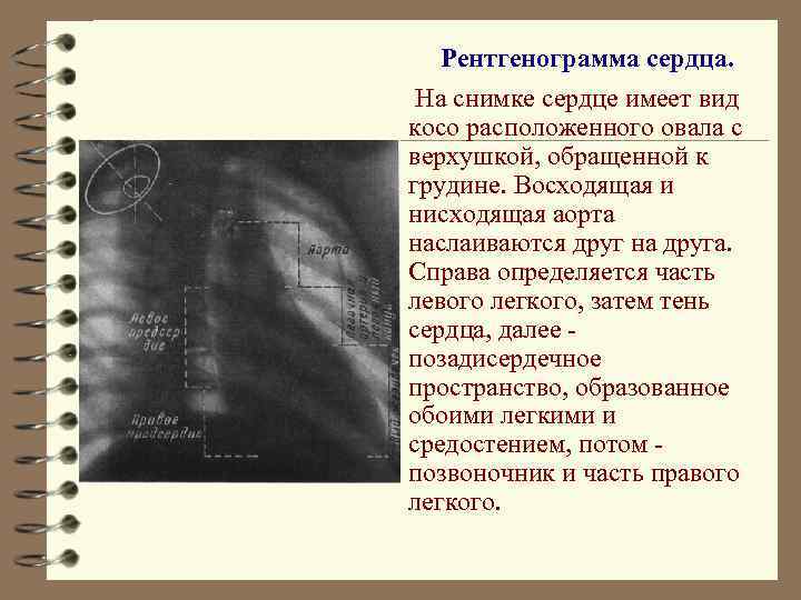 Рентгенограмма сердца. На снимке сердце имеет вид косо расположенного овала с верхушкой, обращенной к