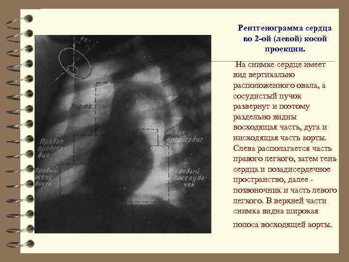 Рентгенограмма сердца во 2 -ой (левой) косой проекции. На снимке сердце имеет вид вертикально