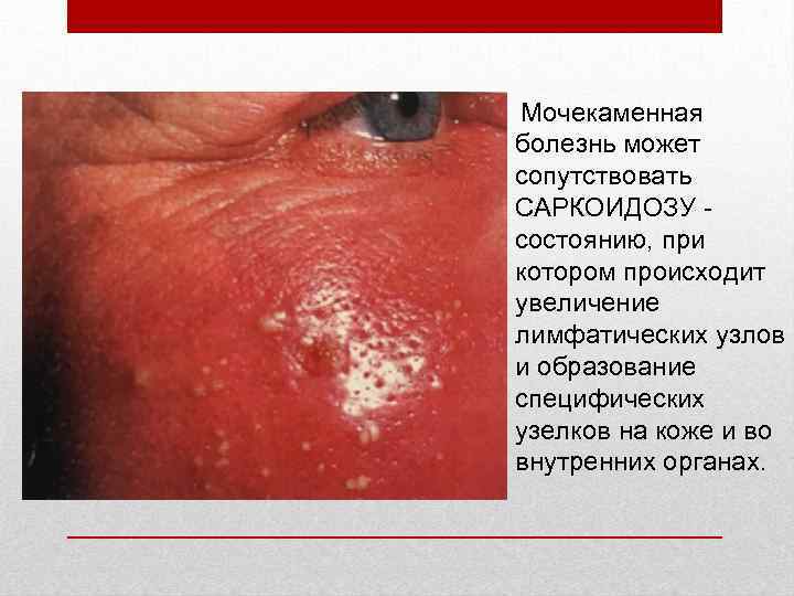  Мочекаменная болезнь может сопутствовать САРКОИДОЗУ - состоянию, при котором происходит увеличение лимфатических узлов