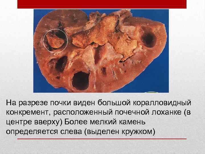 На разрезе почки виден большой коралловидный конкремент, расположенный почечной лоханке (в центре вверху) Более