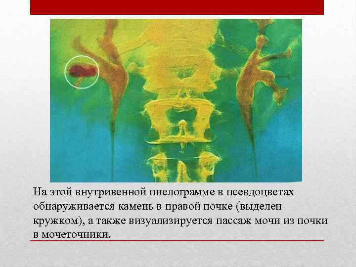 На этой внутривенной пиелorрамме в псевдоцветах обнаруживается камень в правой почке (выделен кружком), а