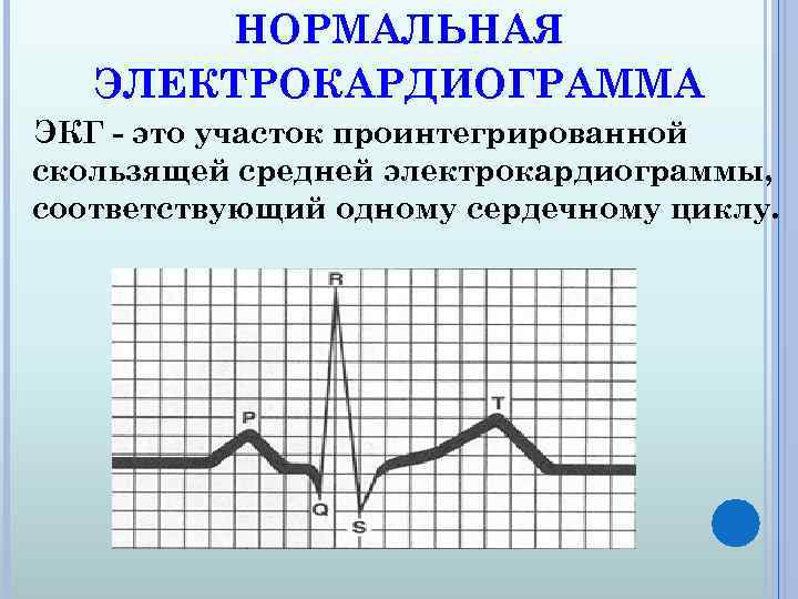 НОРМАЛЬНАЯ ЭЛЕКТРОКАРДИОГРАММА ЭКГ - это участок проинтегрированной скользящей средней электрокардиограммы, соответствующий одному сердечному циклу.