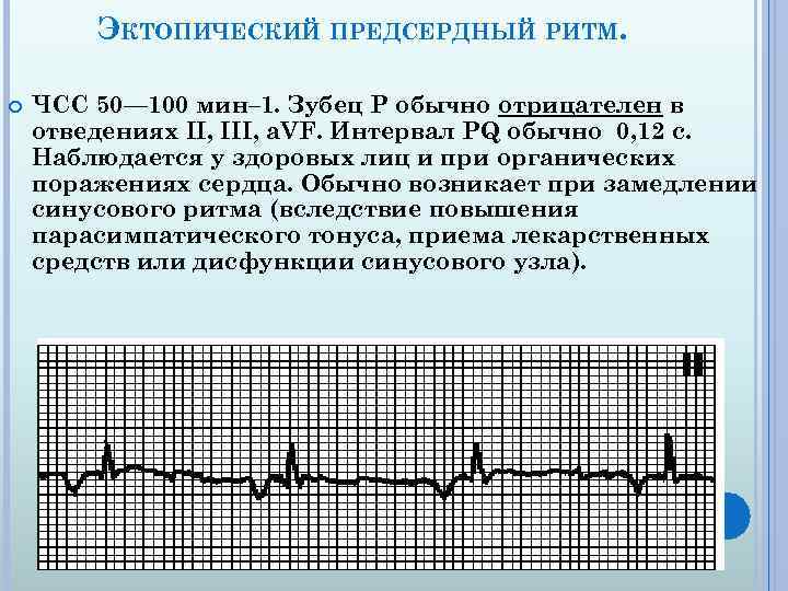 Экг синусовый ритм что это. ЭКГ при предсердном ритме. Предсердный ритм на ЭКГ ЧСС. Предсердный источник ритма на ЭКГ. Эктопический нижнепредсердный ритм на ЭКГ.