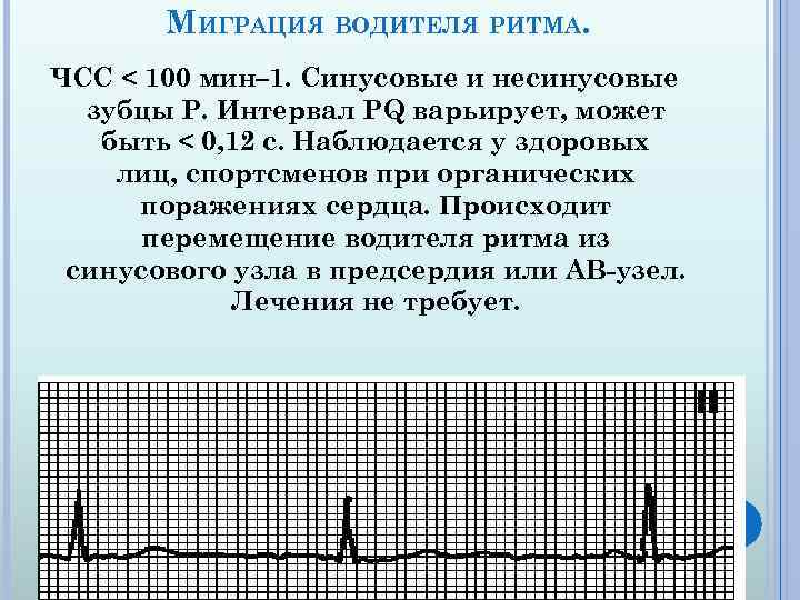 МИГРАЦИЯ ВОДИТЕЛЯ РИТМА. ЧСС < 100 мин– 1. Синусовые и несинусовые зубцы P. Интервал