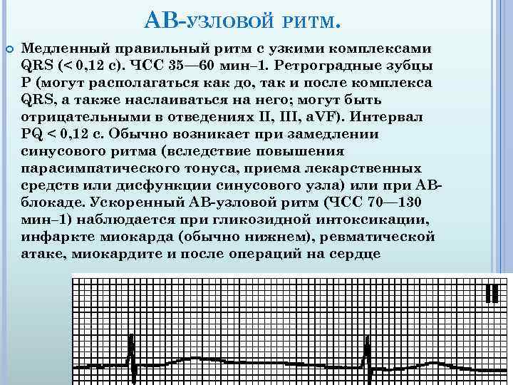 АВ-УЗЛОВОЙ РИТМ. Медленный правильный ритм с узкими комплексами QRS (< 0, 12 с). ЧСС