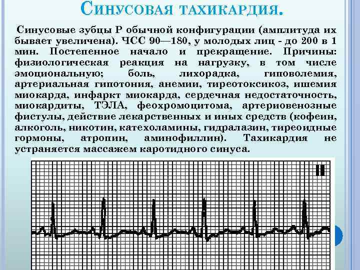 СИНУСОВАЯ ТАХИКАРДИЯ. Синусовые зубцы P обычной конфигурации (амплитуда их бывает увеличена). ЧСС 90— 180,