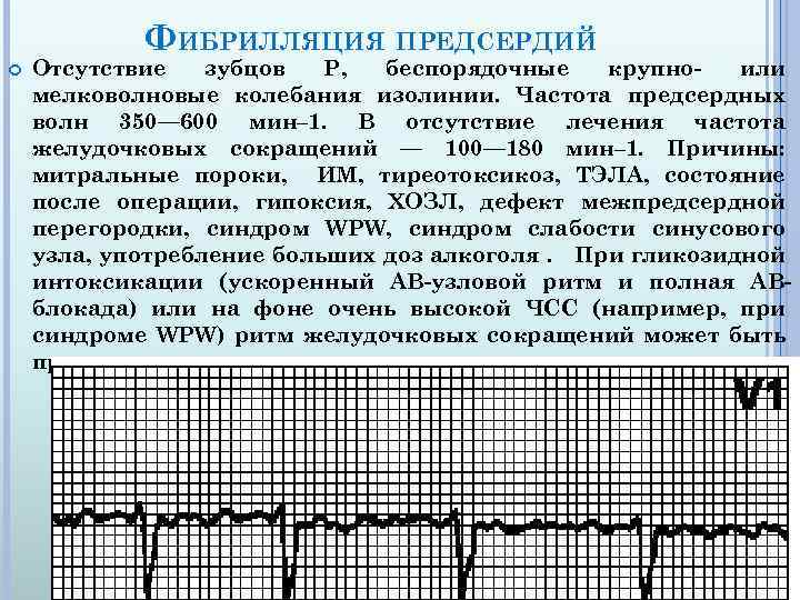 ФИБРИЛЛЯЦИЯ ПРЕДСЕРДИЙ Отсутствие зубцов P, беспорядочные крупноили мелковолновые колебания изолинии. Частота предсердных волн 350—