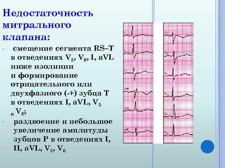 Недостаточность митрального клапана: • • смещение сегмента RS–T в отведениях V 5, V 6,