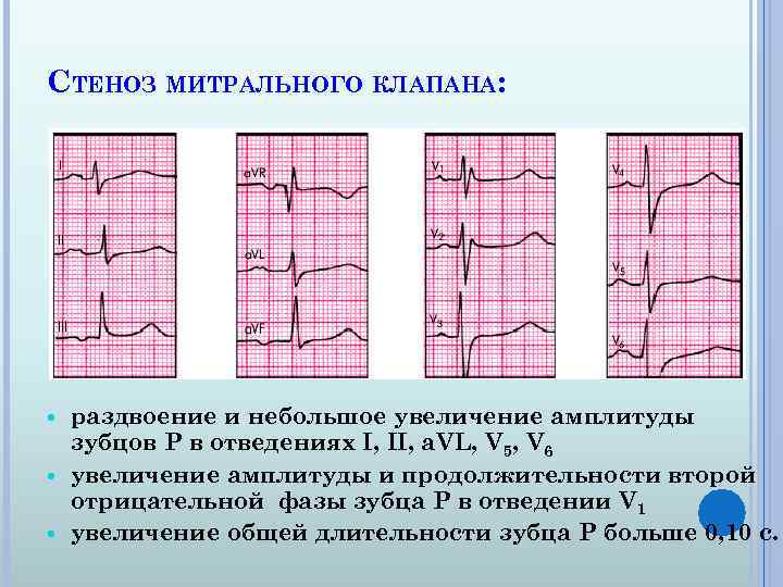 Увеличение амплитуды