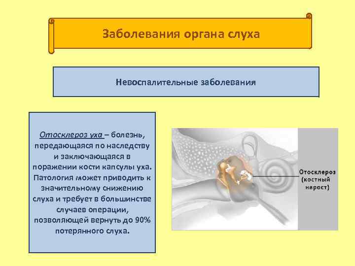 Заболевания органа слуха Невоспалительные заболевания Отосклероз уха – болезнь, передающаяся по наследству и заключающаяся