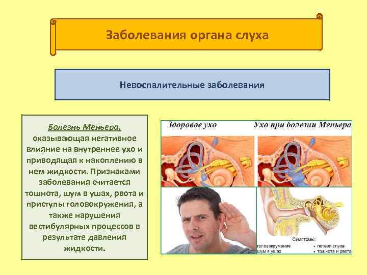 Заболевания органа слуха Невоспалительные заболевания Болезнь Меньера, оказывающая негативное влияние на внутреннее ухо и