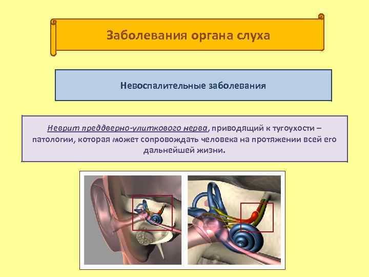 Заболевания органа слуха Невоспалительные заболевания Неврит преддверно-улиткового нерва, приводящий к тугоухости – патологии, которая