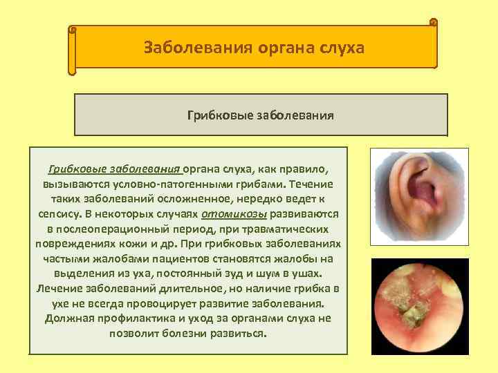 Заболевания органа слуха Грибковые заболевания органа слуха, как правило, вызываются условно патогенными грибами. Течение