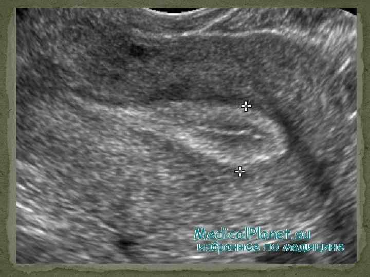 Полость матки неоднородная. М-Эхо 14 мм линейный. Трехслойная структура эндометрия (УЗИ). Гиперэхогенный полип эндометрия. М-Эхо 16 мм неоднородный.