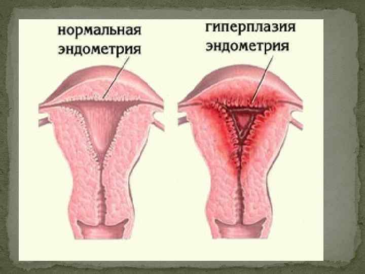 Гиперплазия эндометрия картинки